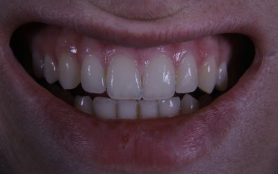 Gum Disease: What You Need to Know