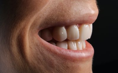 Teeth Grinding: How to Spot the Signs