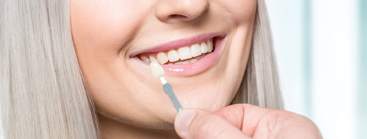 Closeup of woman smiling with slightly yellow teeth