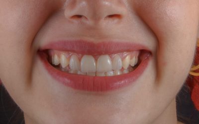 Is ZOOM3! Whitening Right for You?